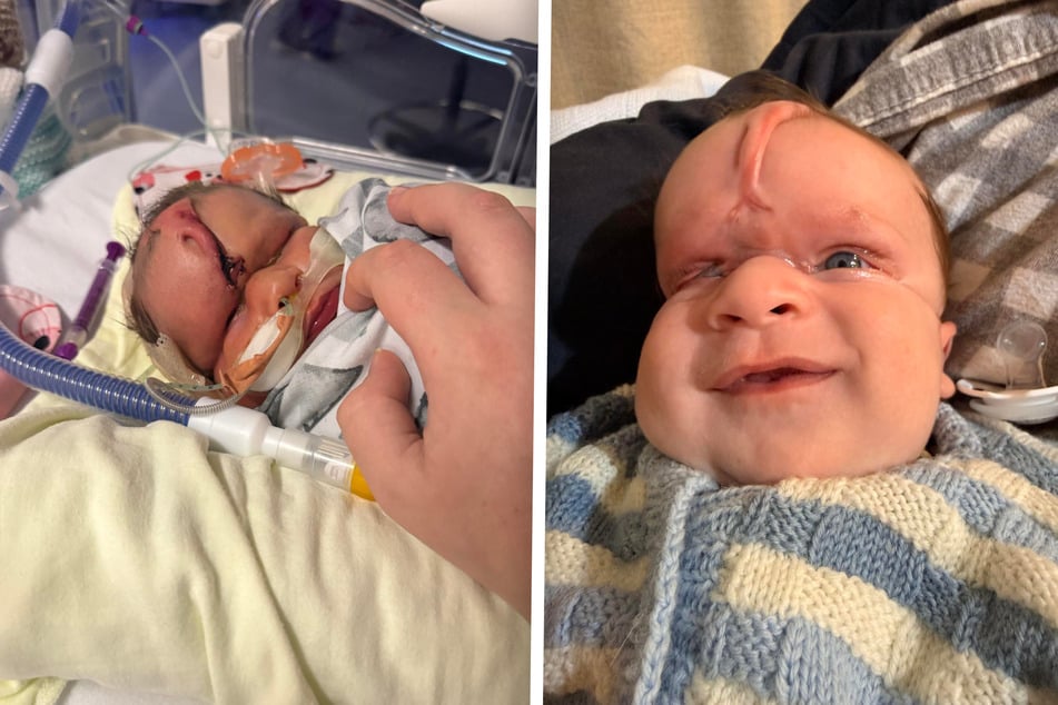 Ollyver kam mit dem Amniotischen-Band-Syndrom (ABS) zur Welt.