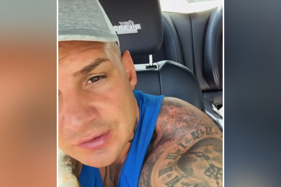 Pietro Lombardi (33) hat sich einen Sonnenbrand zugezogen – mit verheerenden Folgen.