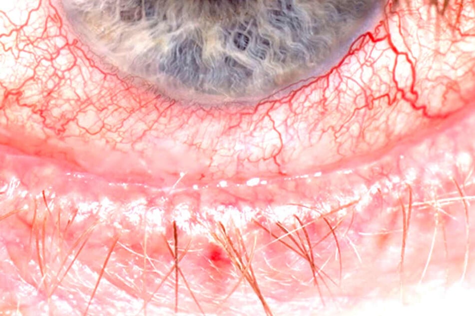 Wenn die Augen rot sind und jucken, denken viele zunächst an eine Bindehautentzündung.