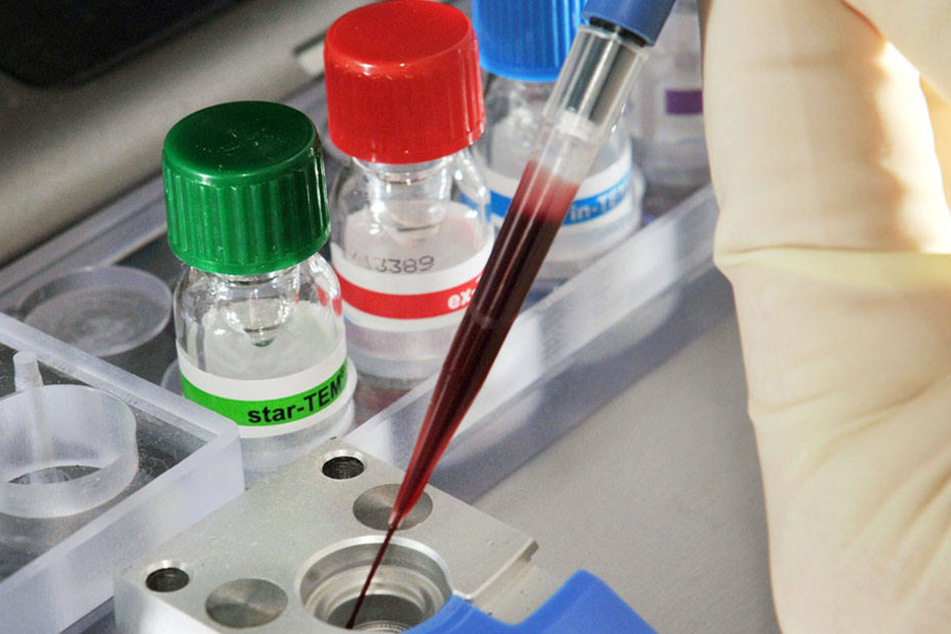 Die Sepsis eines Patienten kann durch eine Blutprobe bestätigt werden.