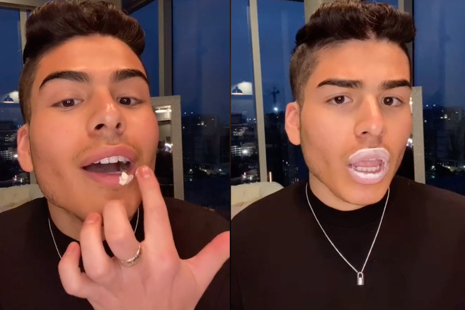 TikToker uses erection cream for fuller lips, the results are disturbing