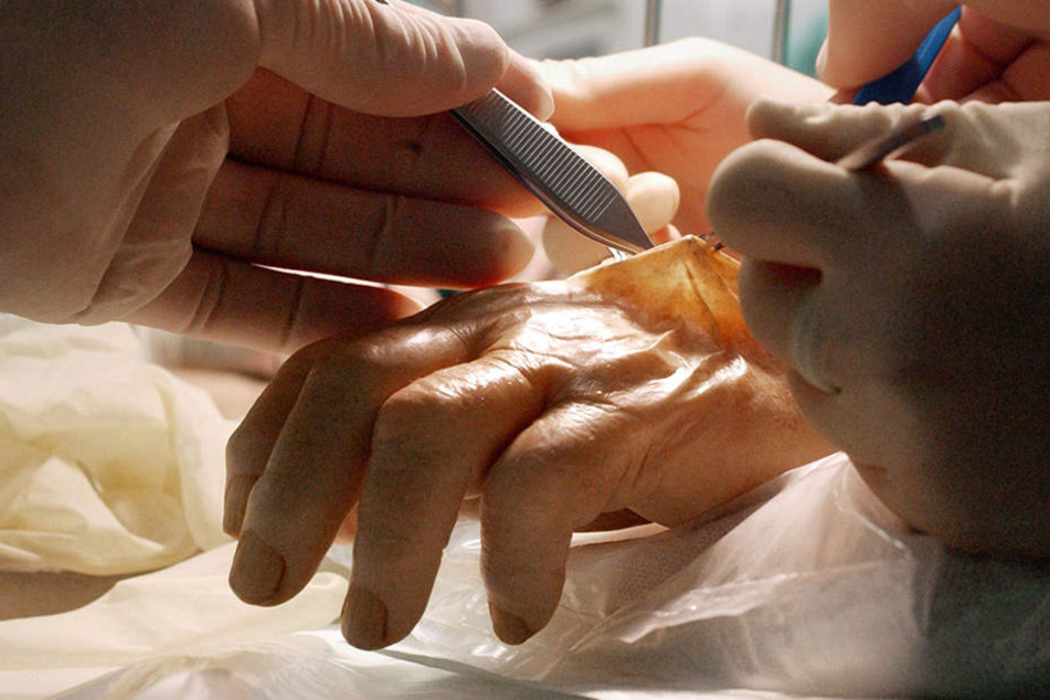 Handchirurgen der plastischen Chirurgie trainieren an einer Leichenhand. (Symbolbild)