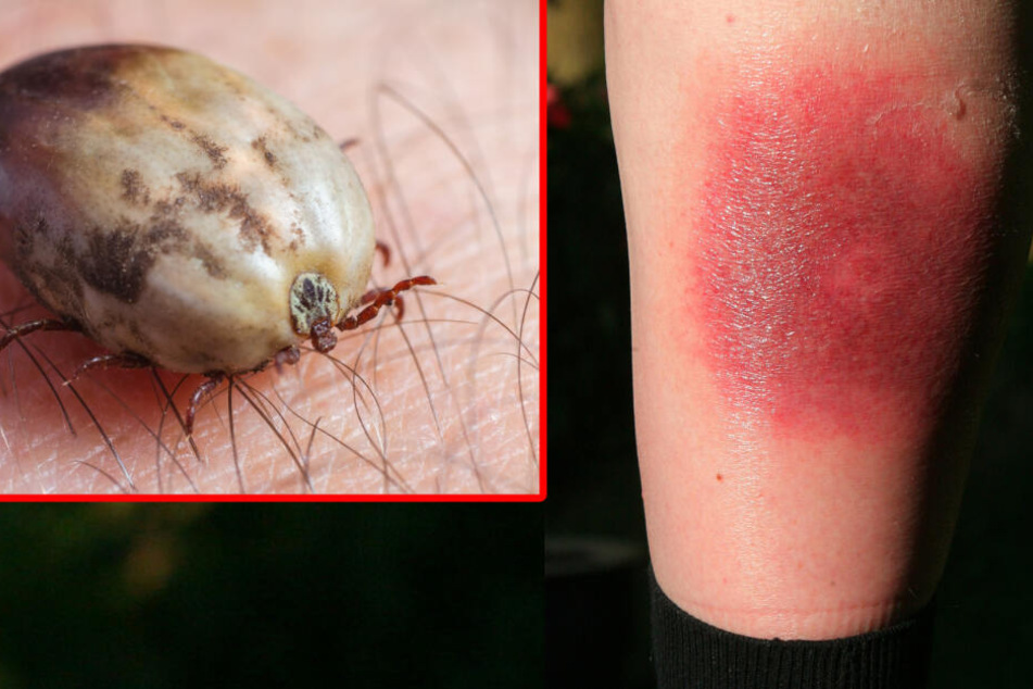 Ein ganz klares Warnzeichen für Borreliose nach einem Zeckenbiss! Die "Wanderröte" kann Tage, oder auch Wochen nach einem Biss auftreten. (Bildcollage)