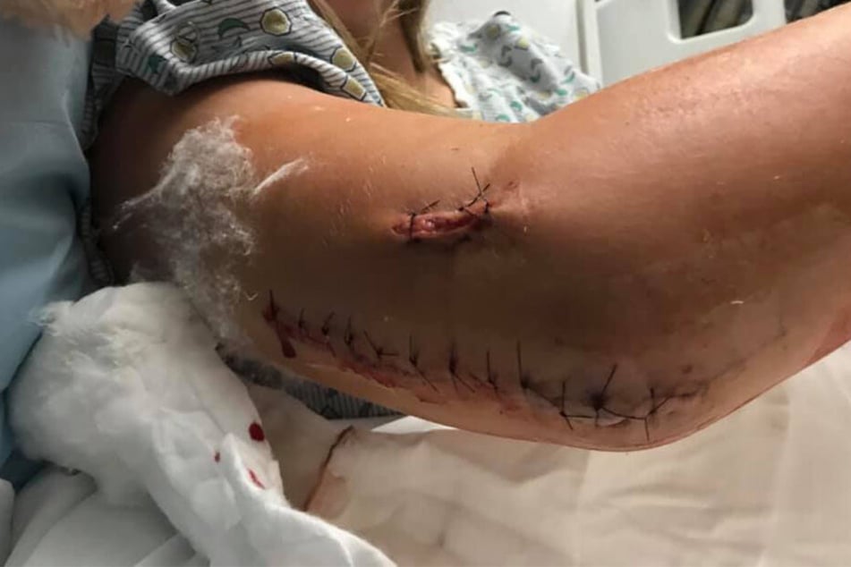 Hanna Jones (18) zeigte ihre schweren Verletzungen auf Facebook.