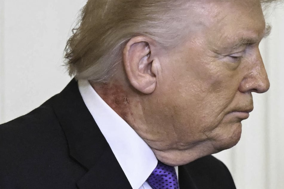 Trump appears with red rash on neck as doctor speaks out