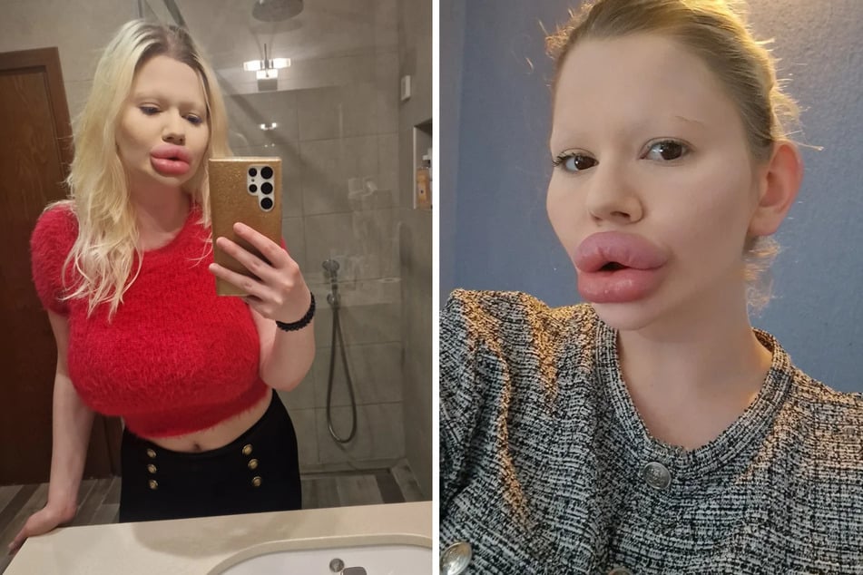 Andrea lässt sich häufig Lipfiller (Hyaluronsäure) spritzen.