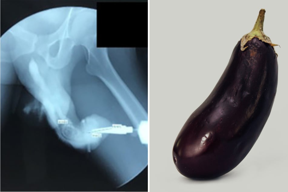 A man who injured his penis during sex was deemed to have Eggplant Deformity after his member bent and turned purple.