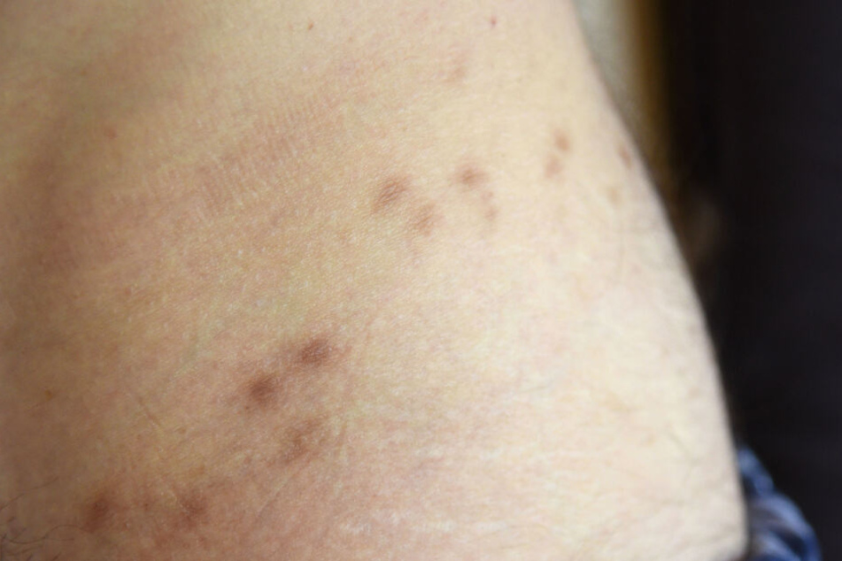Nach einem Krätze-Befall bleiben solche Narben auf der Haut zurück.