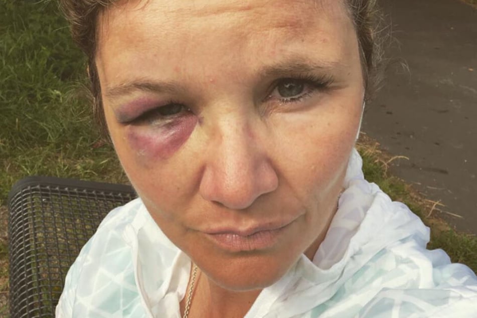 Sandra Kiriasis zog sich ein schmerzhaftes blaues Auge zu.