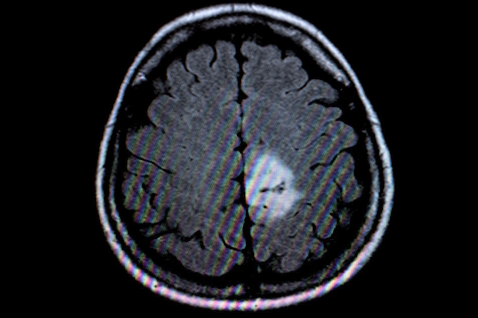 Ein MRT-Bild eines Hirntumors. (Symbolbild)