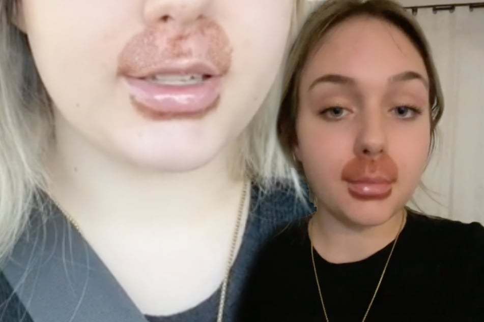 "Verdammt großartig": TikTokerin nach 700-Euro-Lippenbehandlung entstellt, doch sie feiert es
