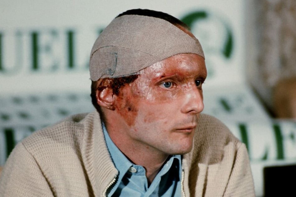 Am 8. September 1976 zeigt Lauda auf einer Pressekonferenz die Spuren seines Unfalls.