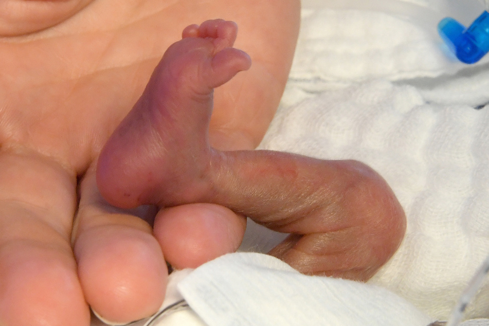 In der Hand einer Pflegekraft liegt der rechte Fuß eines fünf Tage alten und bei der Geburt 430 Gramm wiegenden Jungen. Strenge Corona-Regeln in Geburtenstationen können fatale Folgen für Frühgeborene haben.