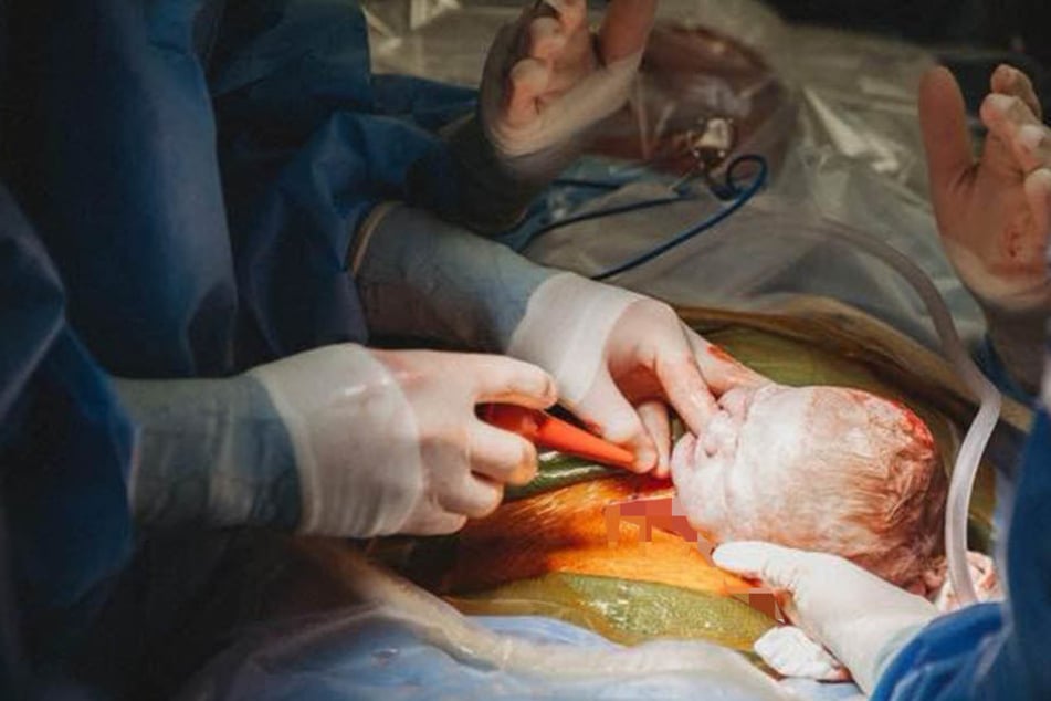 Im entscheidenden Moment packte Emily Dial (34) mit OP-Handschuhen zu. Bei der Geburt trug sie einen Mundschutz.