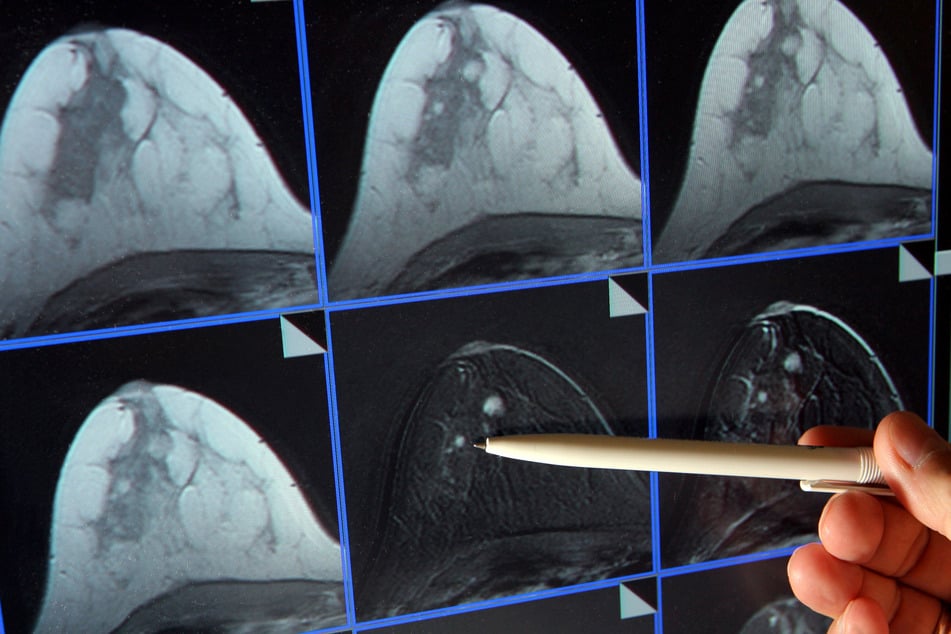 Auf der Bildschirmdarstellung einer Magnetresonanz-(MR)-Mammographie ist ein winziger Tumor in der Brust einer Patientin zu sehen. (Archivbild)