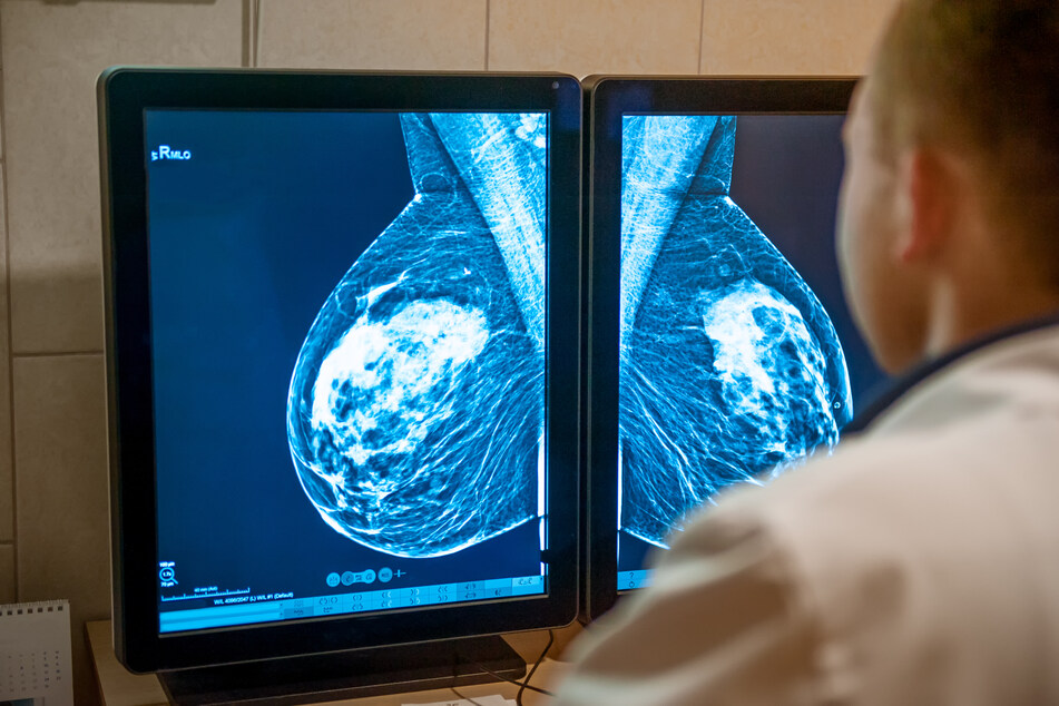 Den Angaben zufolge war der Rückgang bei Brustkrebs und Prostatakrebs noch deutlicher als die rückläufigen Diagnosen bei Hautkrebs. (Symbolbild)