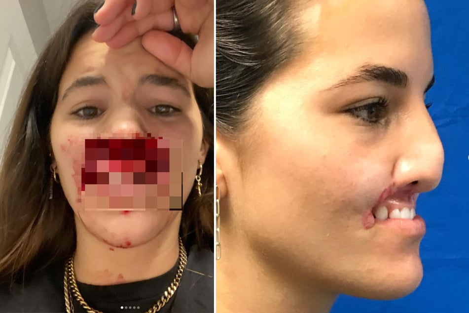 Brooklinn Khoury (23) wurde Ende 2020 von einem Hund angegriffen. Bei der Attacke wurde ihr die gesamte Oberlippe abgebissen.