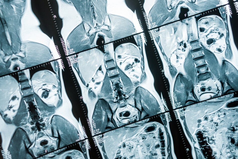 Frau leidet unter Mega-Tumor: Was dahinter unbemerkt wachsen konnte, schockt alle Ärzte