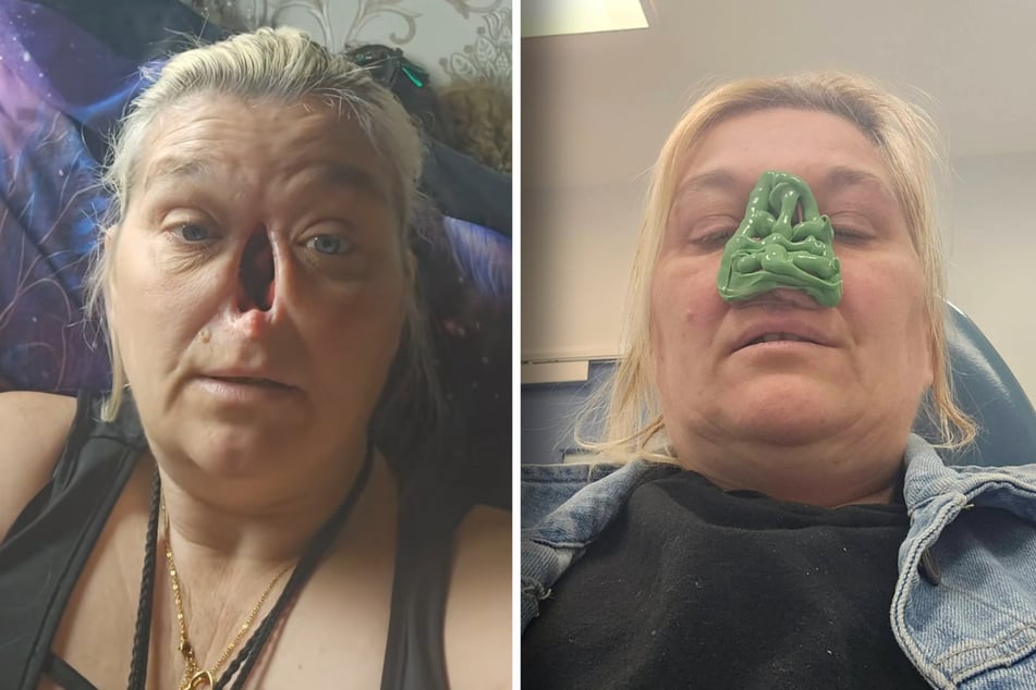 Bei Ellen diagnostizierten die Ärzte Nasenkrebs.