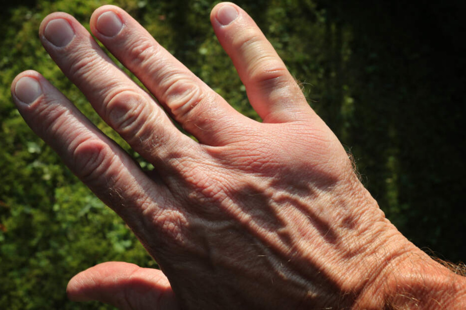Nach einem Wespenstich ist die Hand angeschwollen. (Symbolbild)