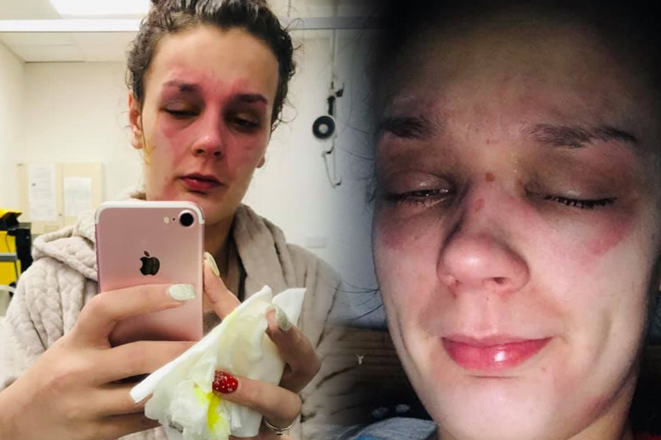 Die 19-Jährige erlitt Verbrennungen in ihrem Gesicht.