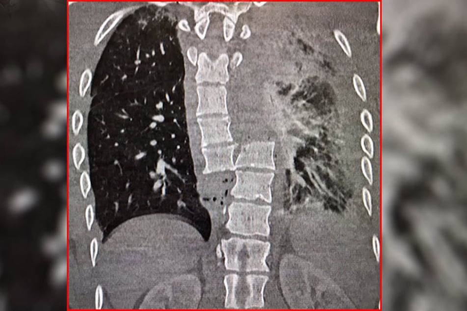 Ein Röntgenbild zeigt die unglaubliche Wirbelsäulenverletzung.