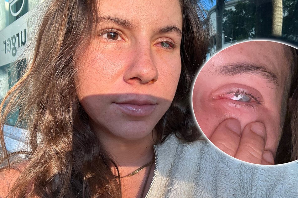 Tagelang Augenschmerzen: Parasit frisst sich durch Auge von Frau