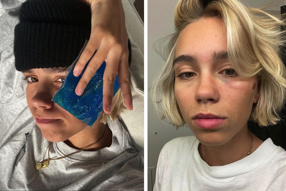 Lena Mantler (21) zeigte Zivilcourage. Bilder ihres verletzten Gesichtes teilte sie auf Instagram.
