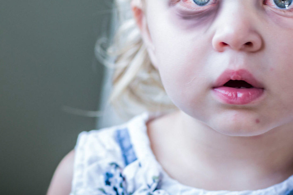 Das kleine Mädchen erlitt ein Schädelhirntrauma. Das Erlebnis wird sie wohl nie vergessen können. (Symbolbild).