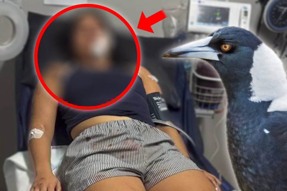 Ataque de ave deja a una mujer gravemente desfigurada y hospitalizada.