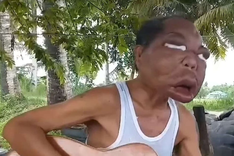 Romulo Pilapil (56) behauptet, dass er seit drei Jahren dieses geschwollene Gesicht hat.