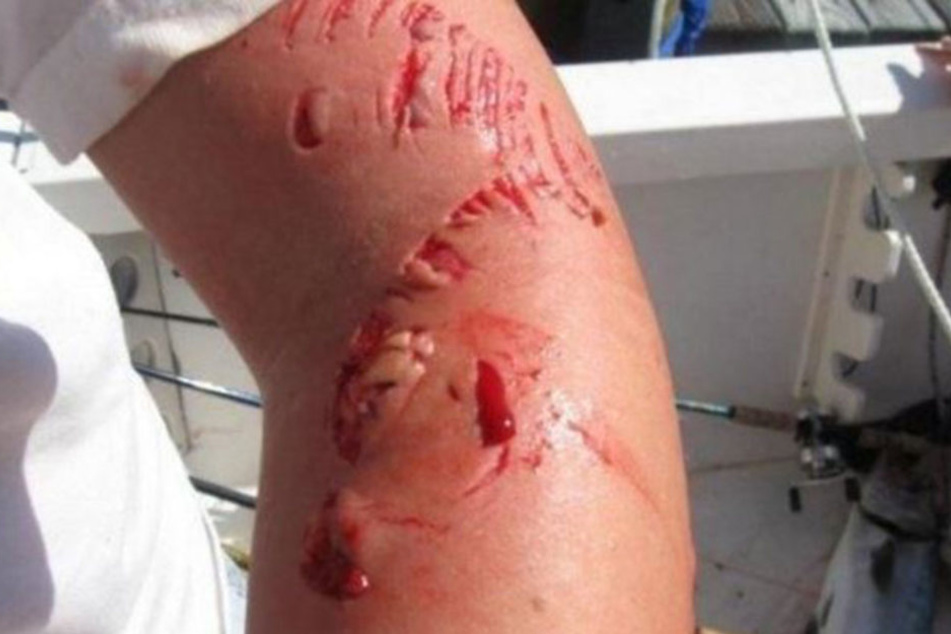 Der Fisch riss im Todeskampf tiefe Wunden in den Arm.