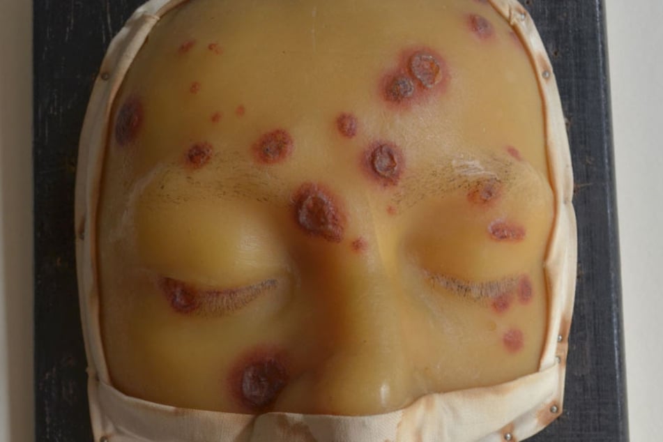 Eine Wachs-Maske zeigt Syphilis-Symptome in einem späteren Stadium.
