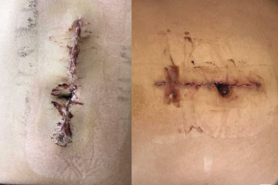 Diese Bilder zeigen die Narbe einen Tag nach der Operation.