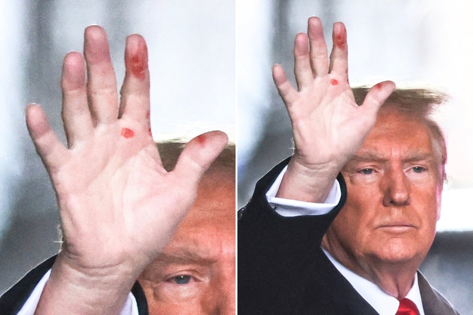 What is going on with Donald Trump's hand?