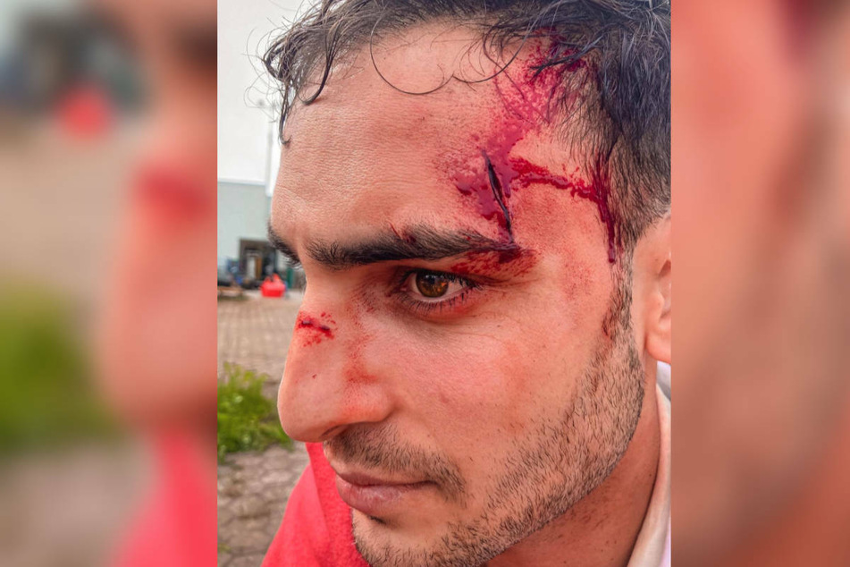 Mit diesem Foto hat Timur Ülker (32) seine Instagram-Community geschockt, doch keine Angst, es handelt sich nur um einen Werbegag.
