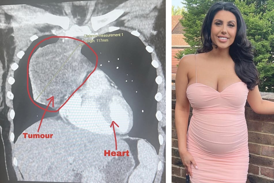 Kurz vor Ende der Schwangerschaft von Zoe Plastiras (23) wurde bei ihr Krebs diagnostiziert.