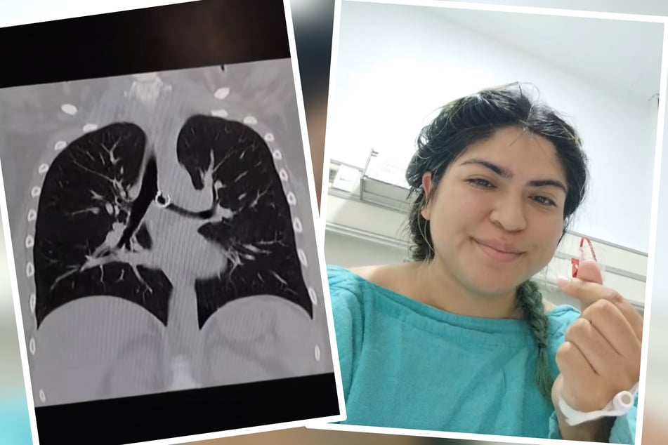 Nachdem Monica wochenlang glaubte, der Husten sei von Wetterumschwüngen verursacht, entdeckte man die wahre Ursache: ein Nasenring in ihrer Lunge.