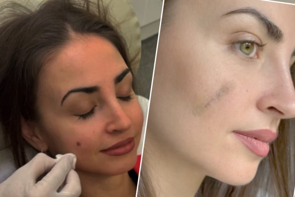 Ekaterina Leonova meldet sich nach OP zu Wort: Muttermal wäre Hautkrebs geworden!