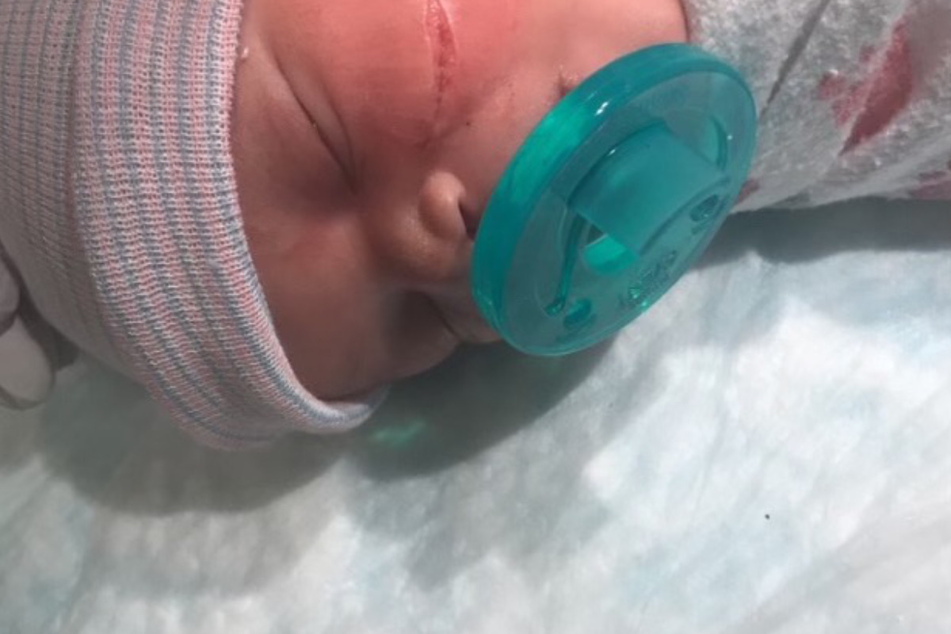 In Denver verletzten die Ärzte bei einem Not-Kaiserschnitt versehentlich die Wange von Baby Kyanni Williams. Die tiefe Wunde musste mit 13 Stichen genäht werden.
