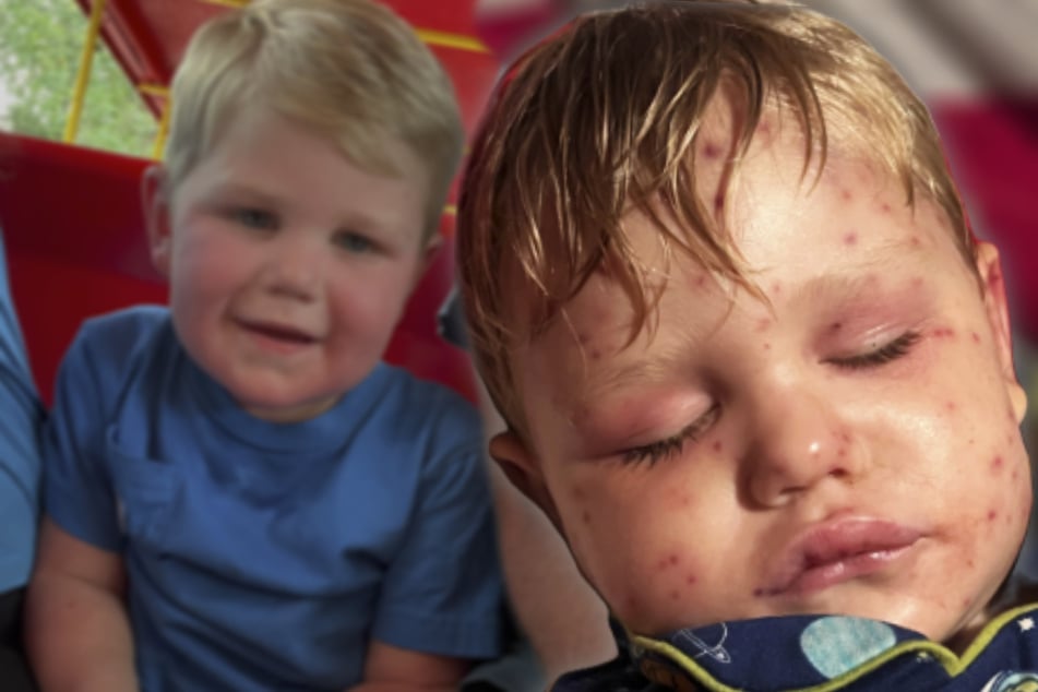 Wespen stechen kleinen Jungen 150-mal: Organe versagen nach Horror-Angriff