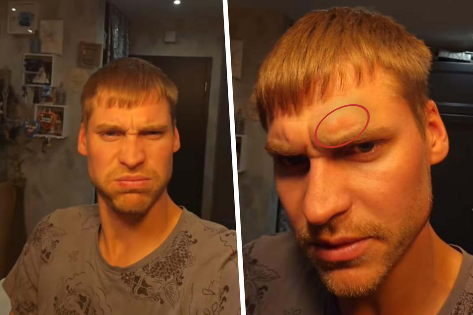 Autsch! Peter Wollny (30) zeigte seinen Instagram-Fans kürzlich seine Beule am Kopf.