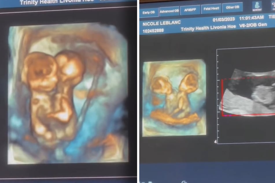 Im 3D-Ultraschall sind die siamesischen Zwillinge gut zu erkennen.