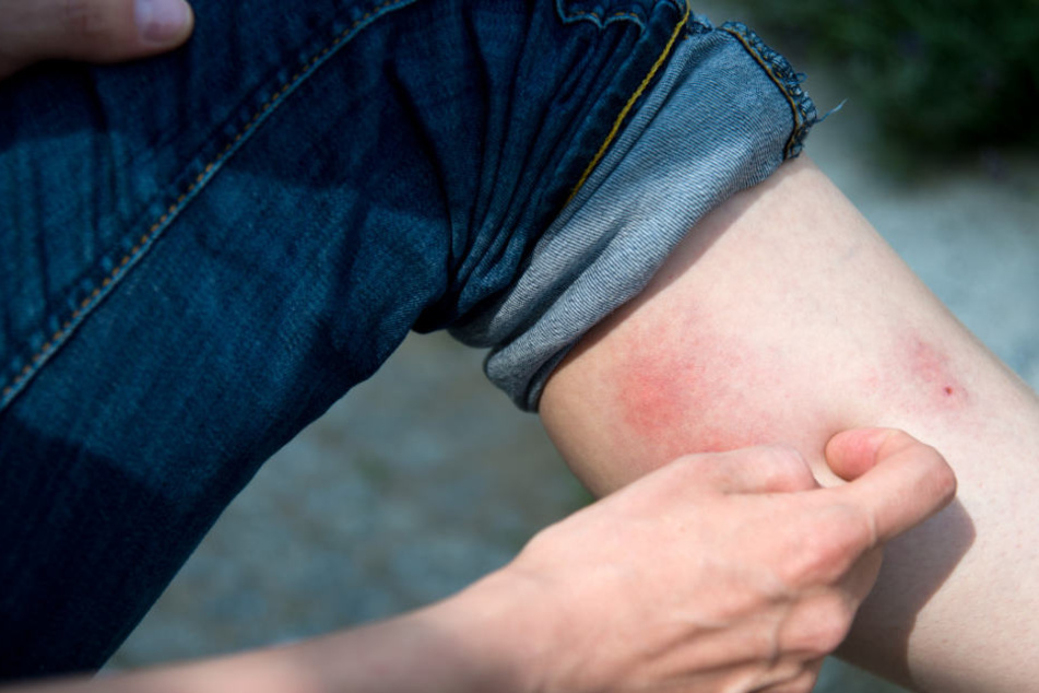 Insektenstiche setzen den Festivalbesuchern in Wacken zu (Symbolbild).