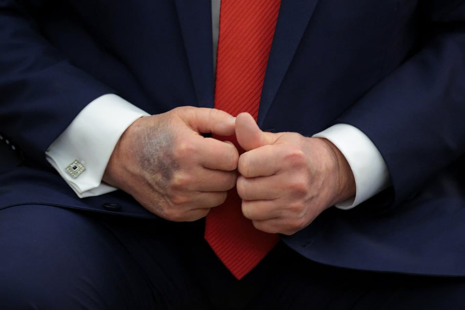 A bruise is visible on the back of President Donald Trump's right hand during a meeting with South Korean President Lee Jae-myung in the Oval Office of the White House on August 25, 2025.