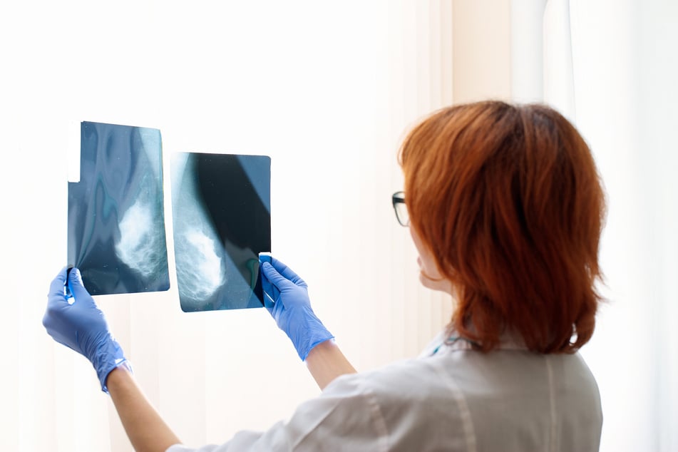 Das Risiko, an Brustkrebs zu erkranken, ist bei einigen Frauen genetisch bedingt erhöht. Das kann durch gezielte Tests erkannt werden.