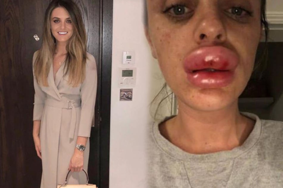 Rachaels Lippen waren nach der Botox-Behandlung extrem angeschwollen.