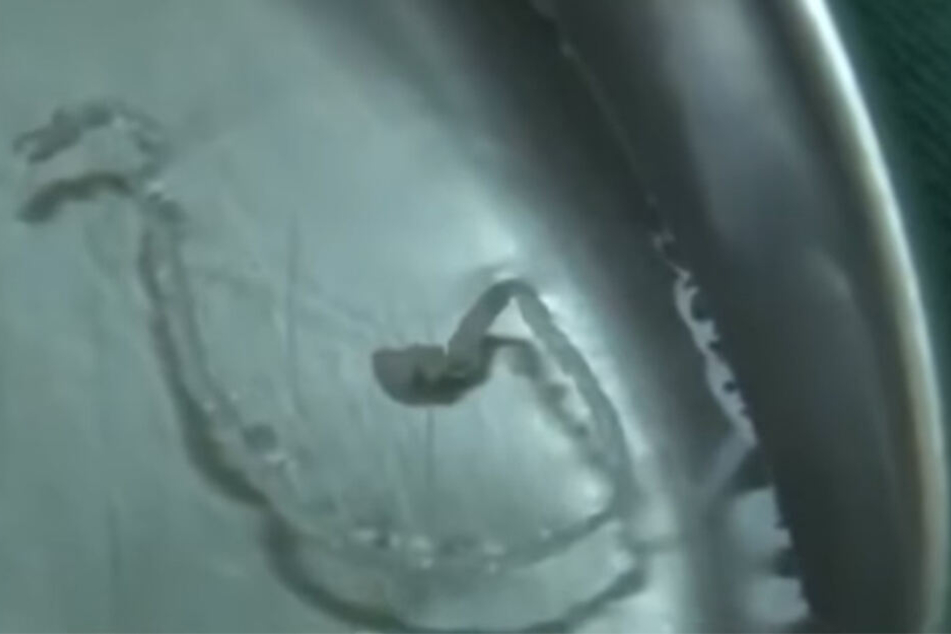 Diesen durchsichtigen, zehn Zentimeter langen Wurm zogen die Ärzte aus dem Kopf des Patienten.