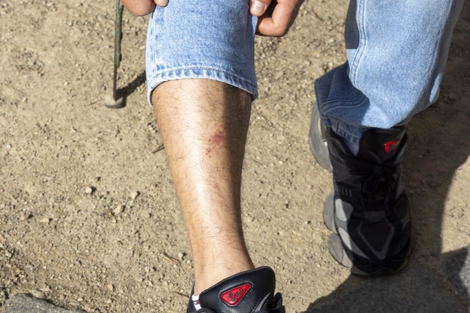 Der Biss hinterließ nur eine leichte Verletzung bei dem Perser.