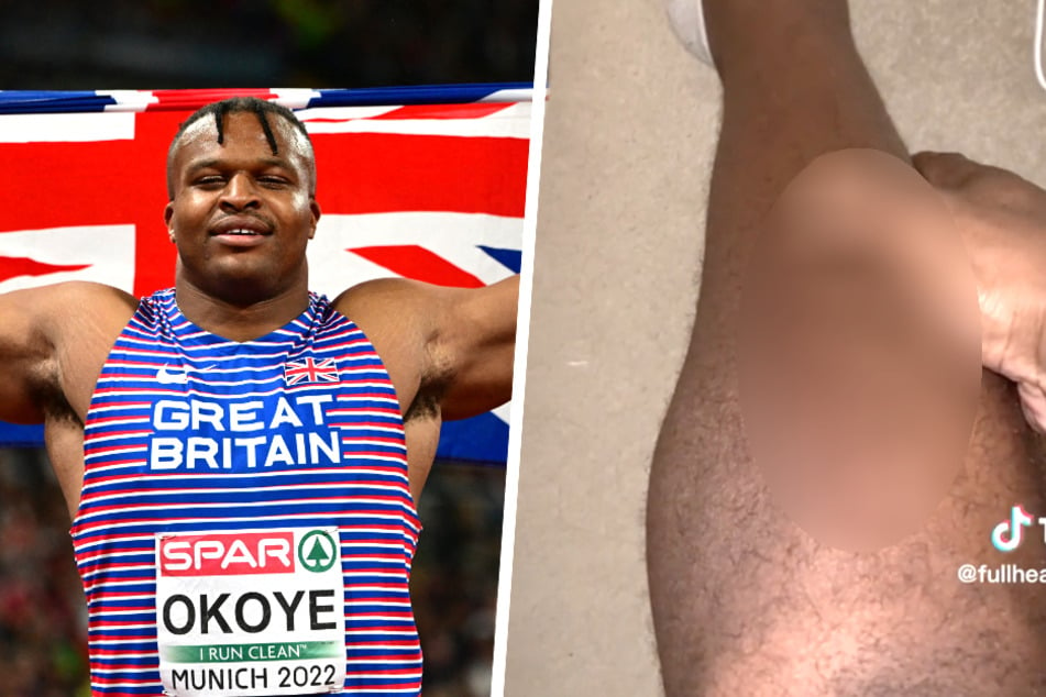 Löcher im Bein? Olympia-Star verstört Follower mit kurioser Verletzung!